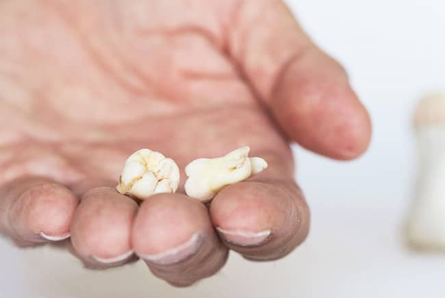 What Are Wisdom Teeth - Wisdom Teeth Removal in Allen, TX - SAKS Dental Studio