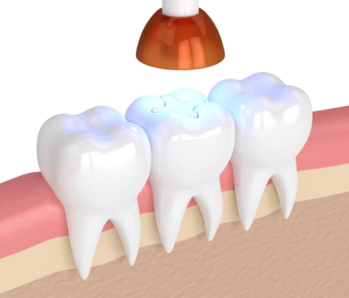 What Happens During The Sealant Procedure - Dental Sealants in Allen, TX - SAKS Dental Studio