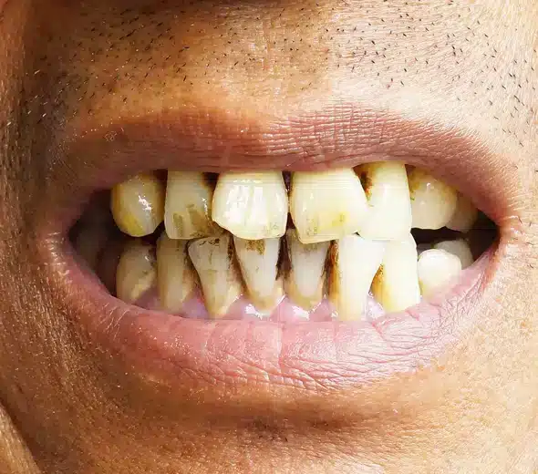 decayed tooth before extraction in allen