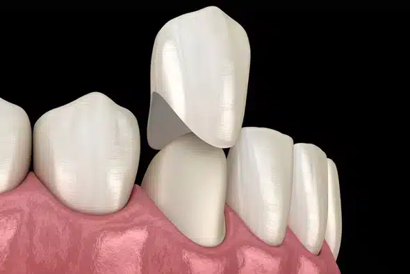 dental crown placement illustration in Allen
