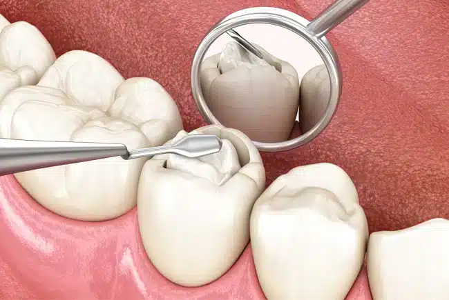 dental filling procedure in allen tx