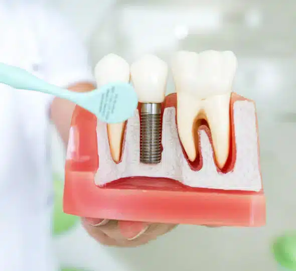 dentist showing dental implants to patient in Allen TX