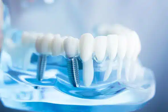 dental implants in Allen TX for missing teeth replacement