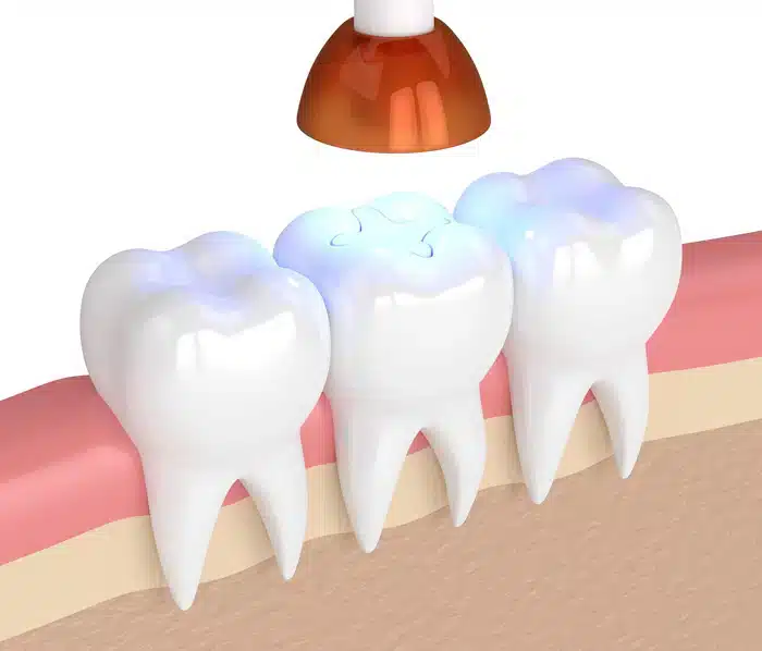 dental sealant procedure in Allen, TX