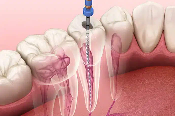 root canals in Allen, TX